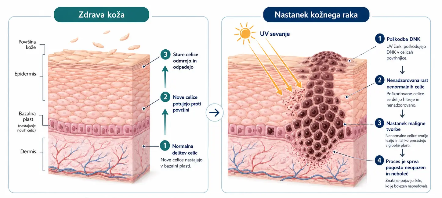 Infografika prikazuje nastanek kožnega raka zaradi poškodb DNK, nenadzorovane rasti kožnih celic in vpliva UV sevanja