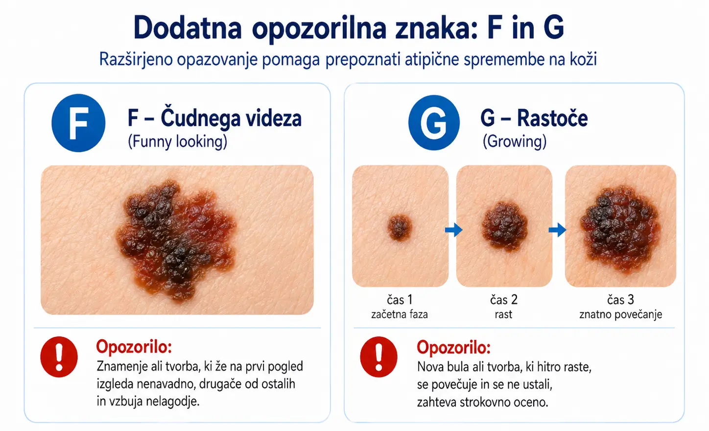 Infografika prikazuje dodatna opozorilna znaka F in G za prepoznavanje atipičnih kožnih sprememb: nenavaden videz znamenja in hitro rast tvorbe.