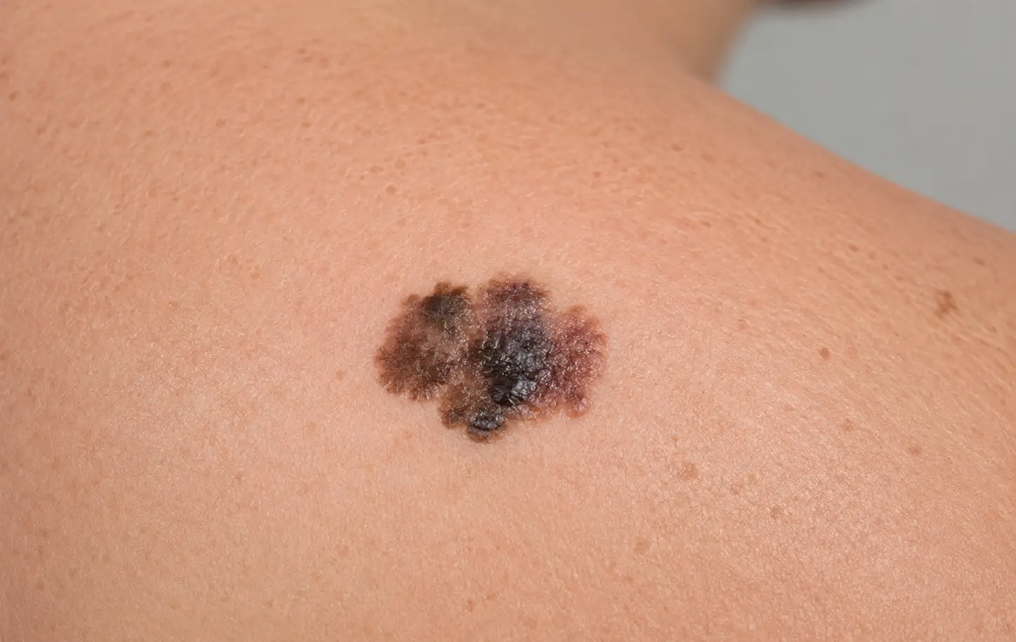 Bližnji posnetek malignega melanoma na koži z nepravilnimi robovi, asimetrično obliko in več odtenki rjave ter črne barve