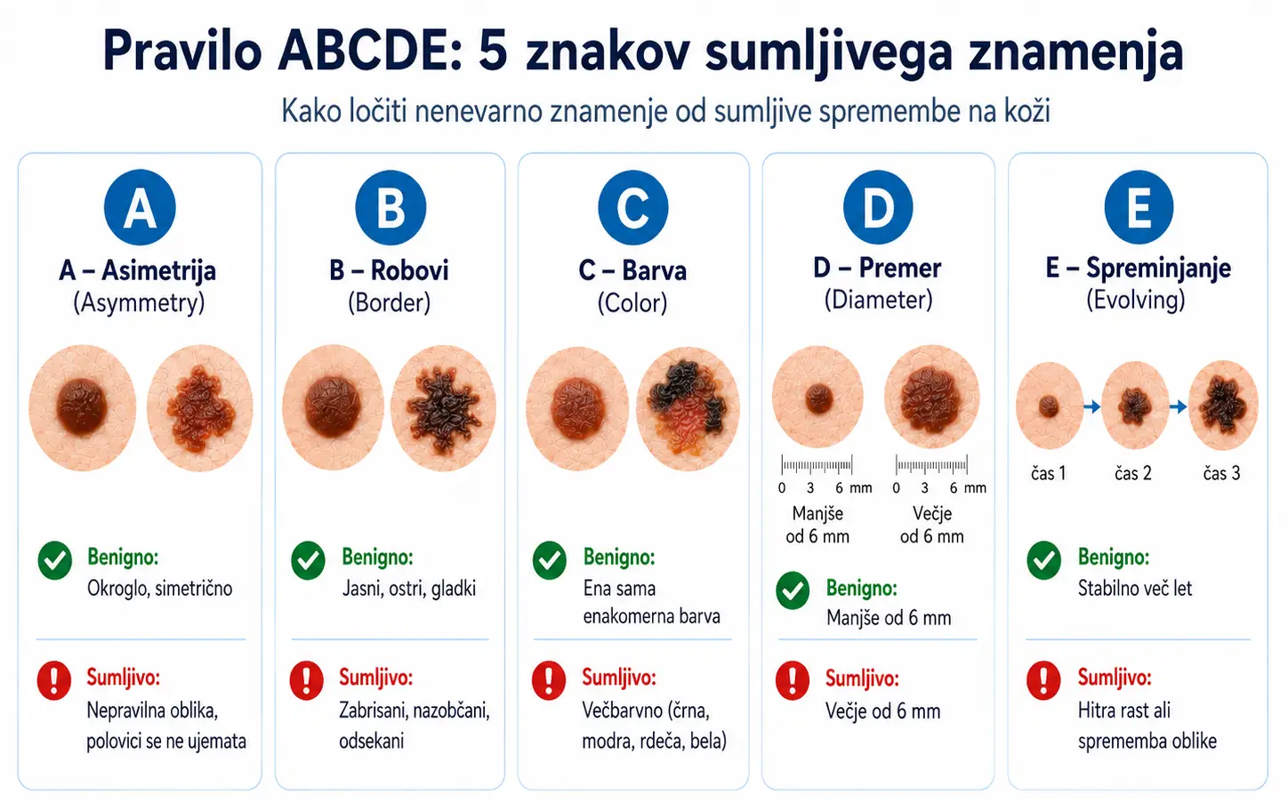 Infografika prikazuje pravilo ABCDE za prepoznavanje sumljivih kožnih znamenj: asimetrijo, robove, barvo, premer in spreminjanje.