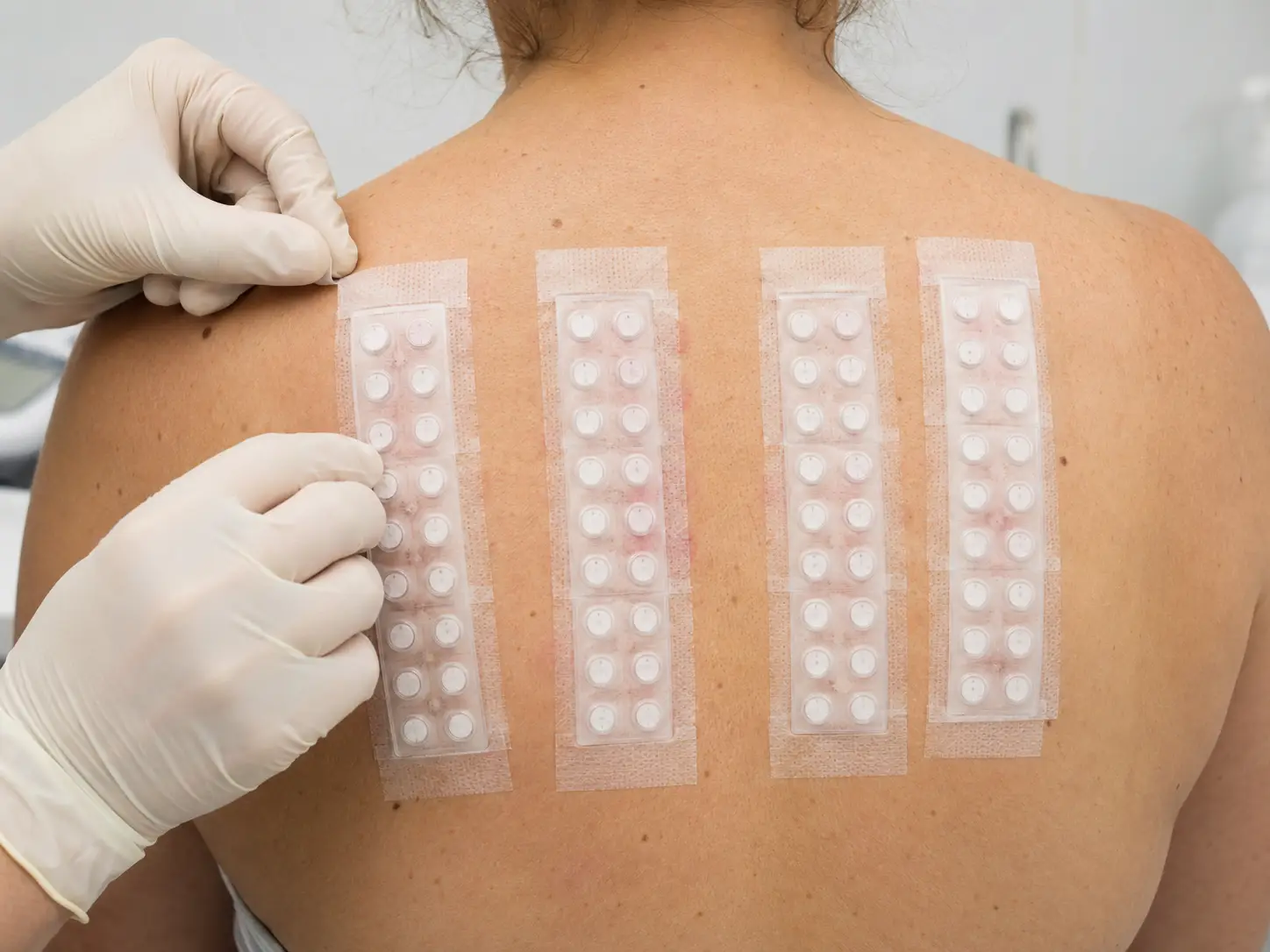 Epikutano testiranje na hrbtu z obliži za odkrivanje alergijskega kontaktnega dermatitisa.