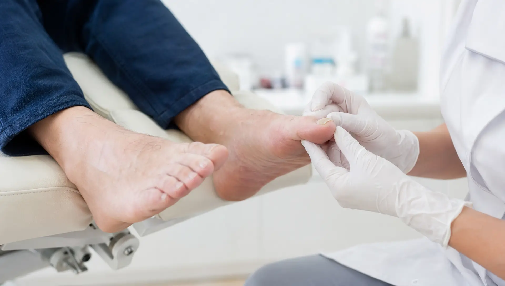Dermatolog pregleduje noht na palcu z znaki onihomikoze – rumenkasto razbarvanje in zadebelitev nohtne plošče.
