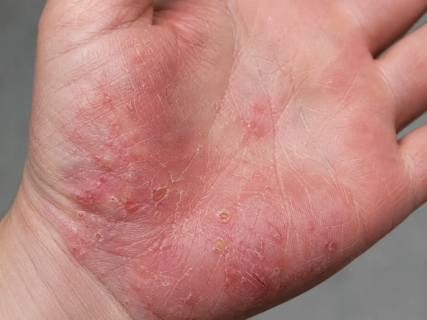 Prikaz kontaktnega dermatitisa na notranji strani dlani z rdečino, suho kožo, luščenjem in drobnimi mehurčki.