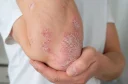 uskavica na komolcu z značilnimi srebrnkastimi luskami