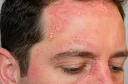 Close-up fotografija seboroičnega dermatitisa na obrazu z rdečico, luščenjem kože ob lasišču, obrveh in nosu.