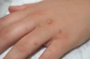 Close-up fotografija roke z več virusnimi bradavicami na prstih in hrbtni strani dlani.