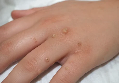 Close-up fotografija roke z več virusnimi bradavicami na prstih in hrbtni strani dlani.
