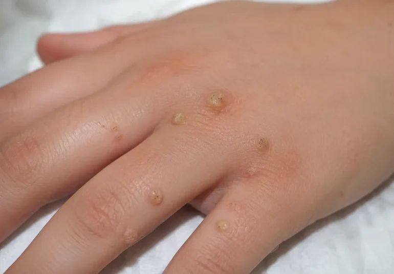 Close-up fotografija roke z več virusnimi bradavicami na prstih in hrbtni strani dlani.