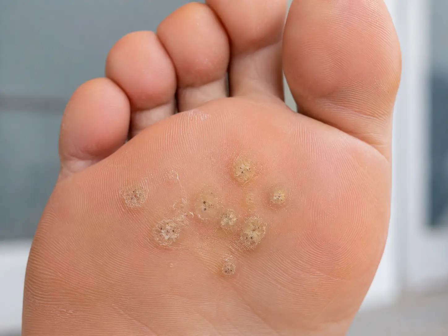 Close-up fotografija podplata z več virusnimi bradavicami na sprednjem delu stopala.