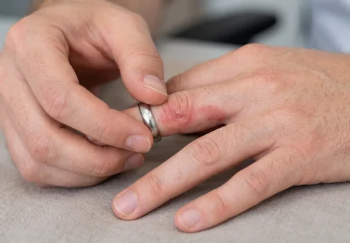 Bližnji posnetek moških rok na mizi. Prstanec nosi srebrn prstan, pod katerim je koža pordela in vneta, kar kaže na kontaktni dermatitis.