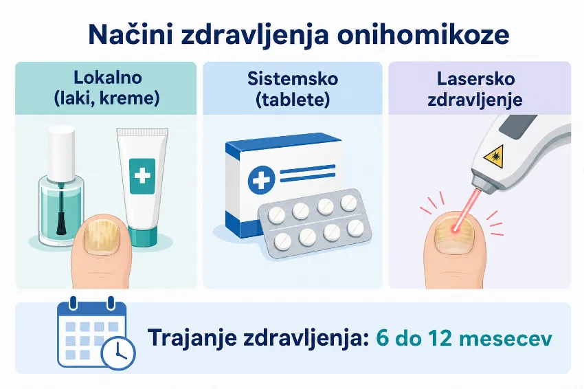 Infografika s primerjavo lokalnega, sistemskega in laserskega zdravljenja glivic na nohtih.