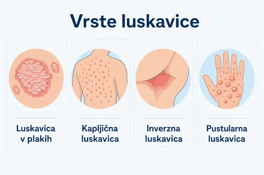 Infografika vrste luskavice: plaki, kapljična, inverzna, pustularna
