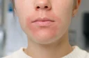Perioralni dermatitis z izpuščajem okoli ust
