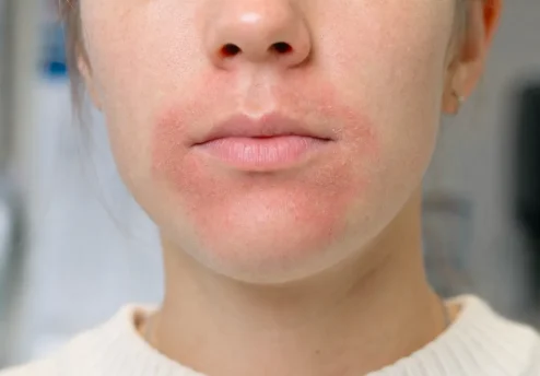 Perioralni dermatitis z izpuščajem okoli ust