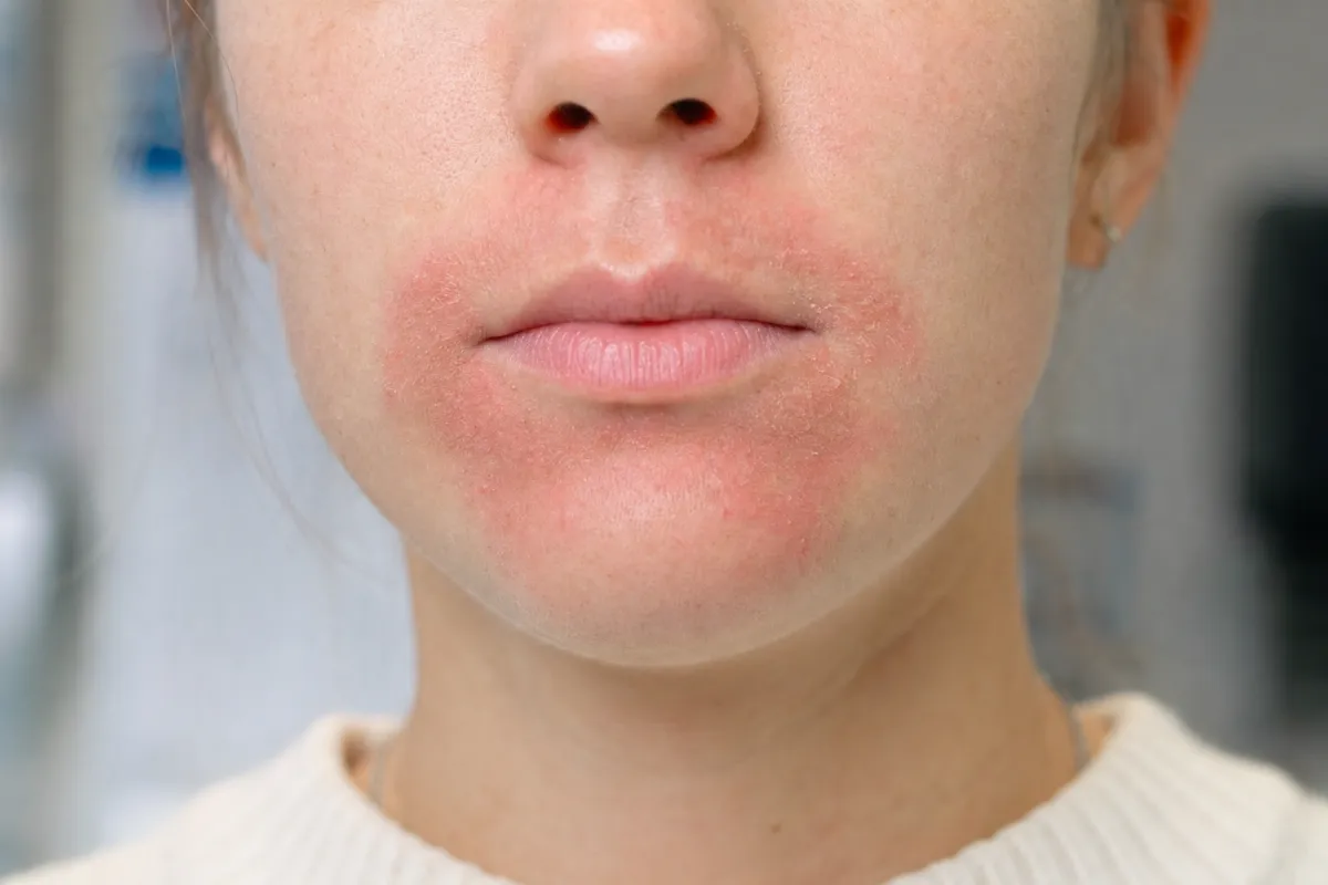 Perioralni dermatitis z izpuščajem okoli ust
